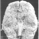Illustration for article titled Doctors Discover A Woman With No Cerebellum